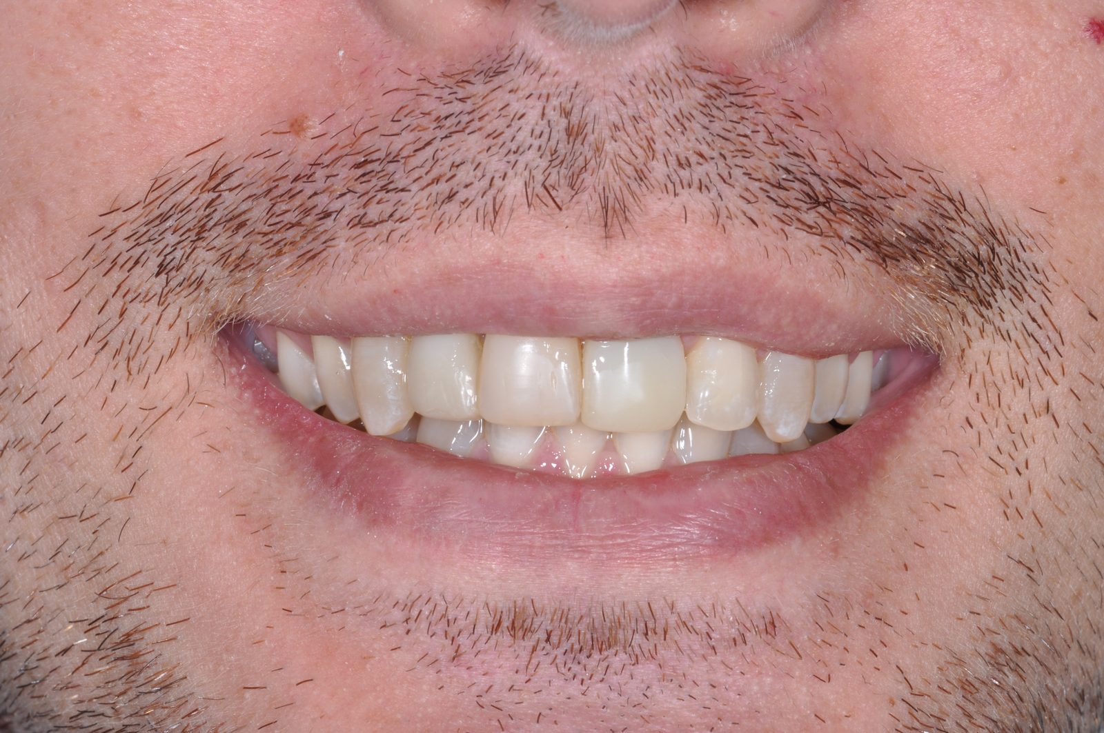 Antes — Implantes Dentales + Blanqueamiento