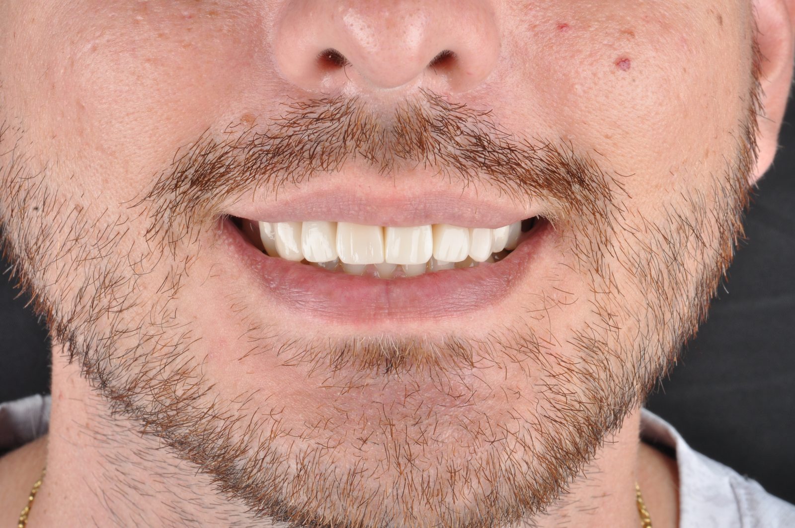 Después — Implantes Dentales + Blanqueamiento